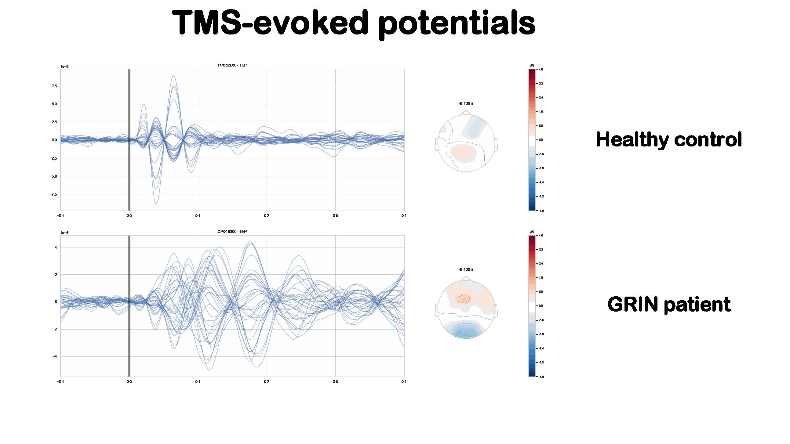 TMS-evoked potentials comparison between healthy control and GRIN patient.